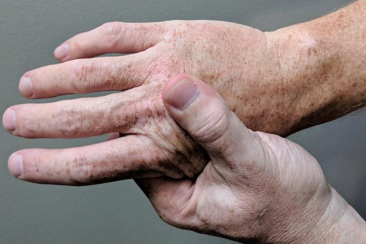 Arthritic hands. Image by Ian Furst / Wikimedia
