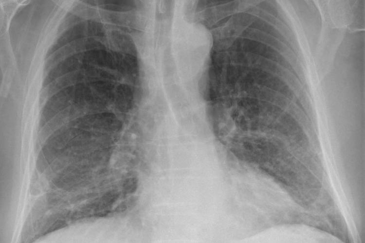COVID-19 chest x-ray. Image by Hellerhof CC-BY-SA-4.0