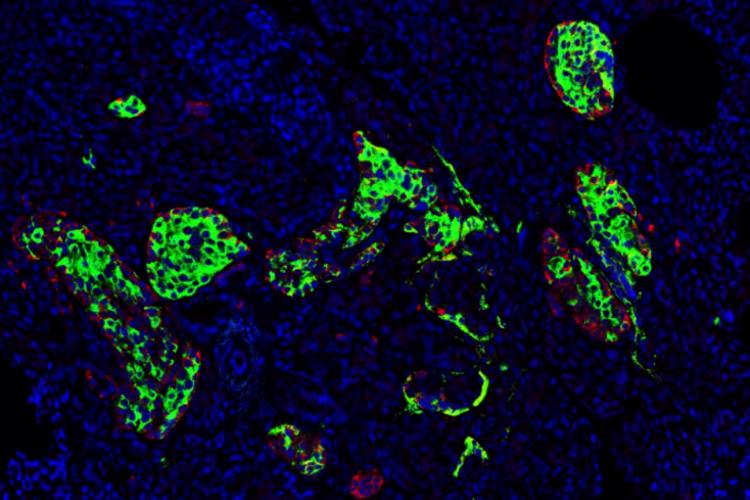 Pancreatic cells from a person with type 1 diabetes. Picture credit: University of Siena &amp; University of Pisa